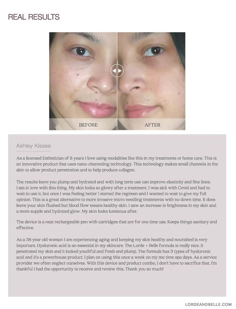 2 Lorde + Belle RegenPen Skincare Devices - Picture 7 of 9